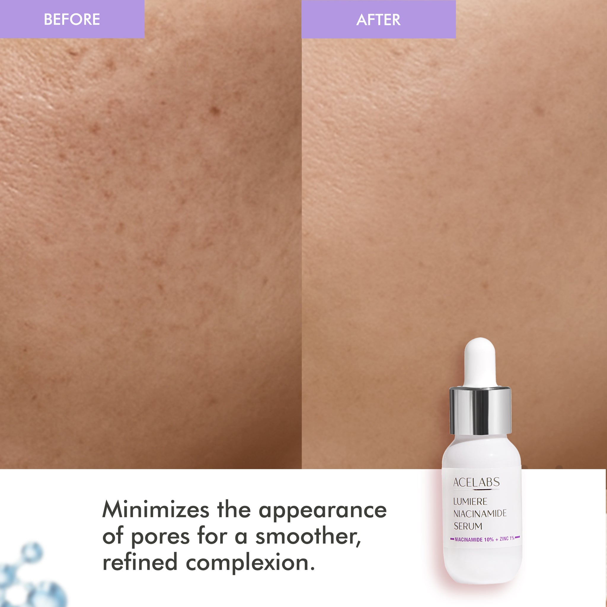 Before and After Using Niacinamide Face Serum – Minimizes Open Pores and Refines Skin Texture