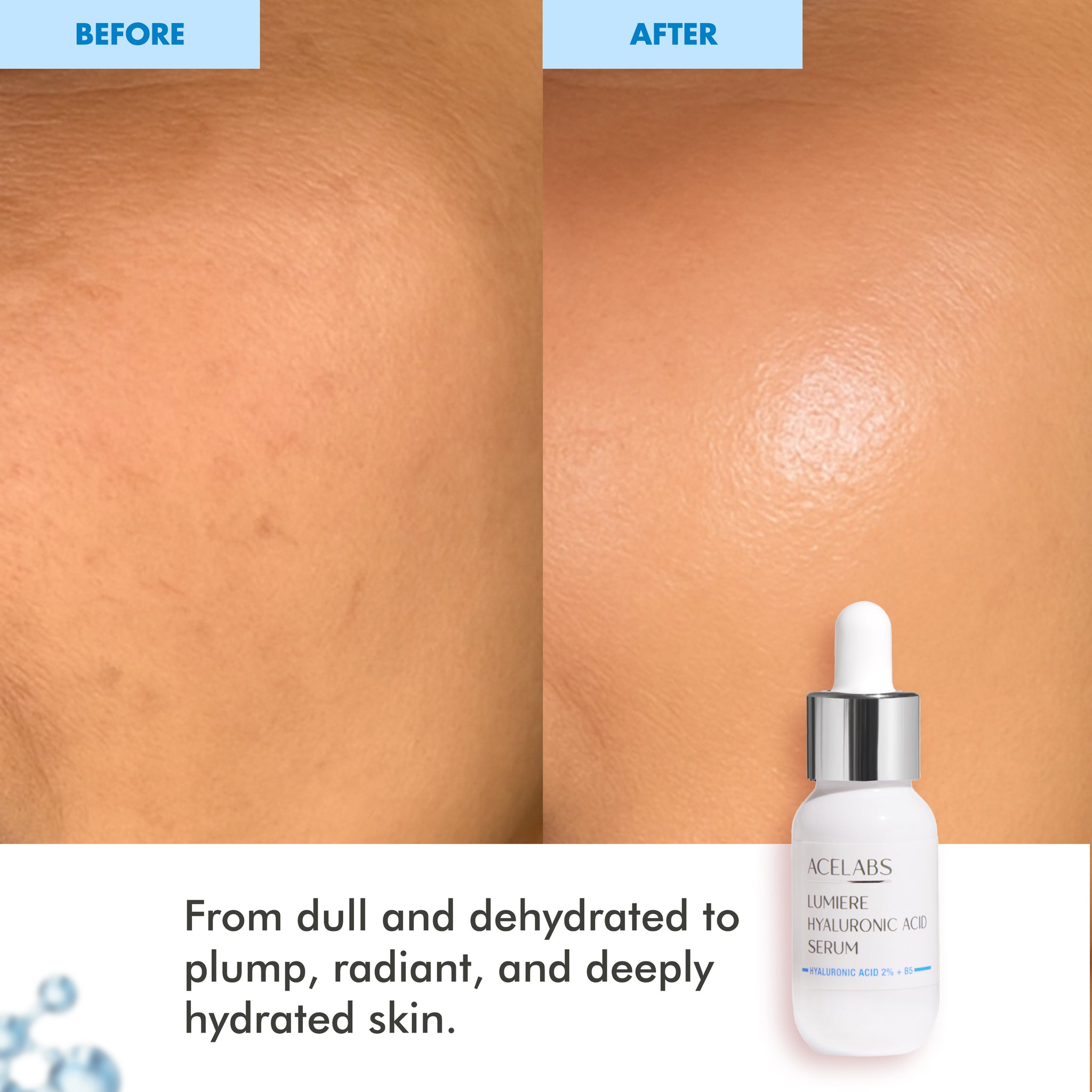 Hyaluronic acid serum before and after results – transforms dull dehydrated skin to radiant and plump